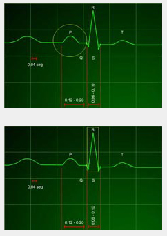 analisis ritmo cardiaco