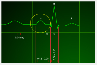 interpretacion ritmo cardiaco