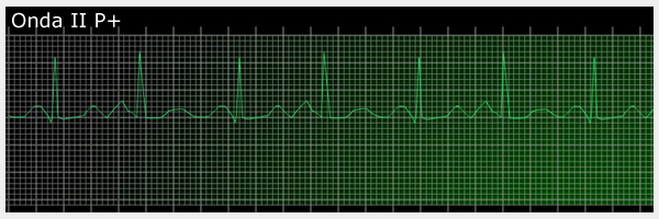 interpretacion ritmo cardiaco