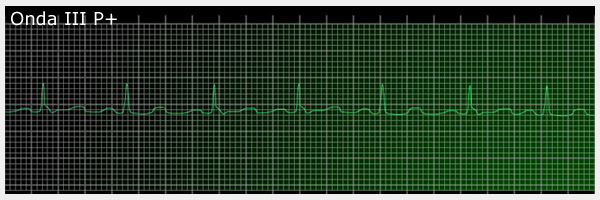 interpretacion ritmo cardiaco