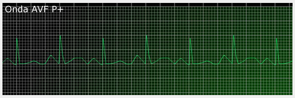 interpretacion ritmo cardiaco