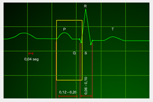 interpretacion ritmo cardiaco