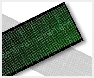 interpretacion ritmo cardiaco