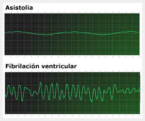 Asistolia y fibrilacin ventricular